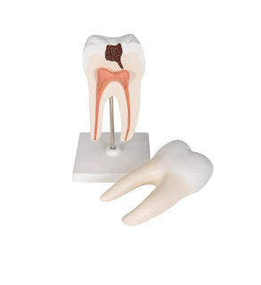 Molar inferior cu radacina dubla